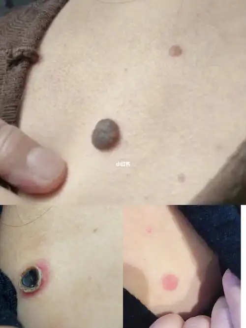 背部大的皮内痣瘤