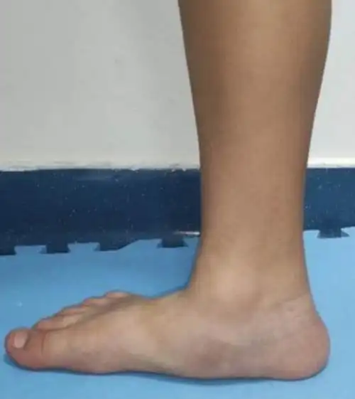 平足怎么治疗最有效(扁平足的危害及治疗方法) | 说明书网