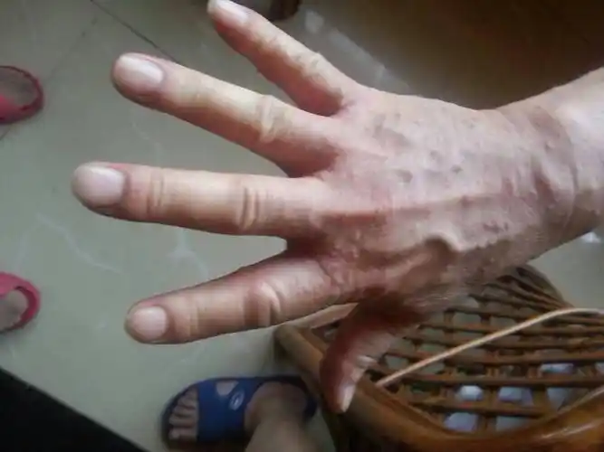 得了疥疮,外用硫软膏用几天用到什么程度,就是治愈了_百度知道