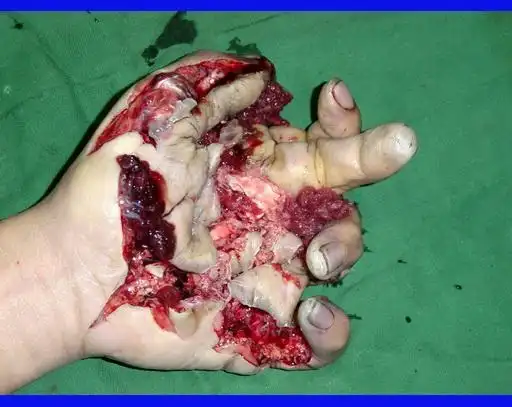 腹部皮瓣 - 修复重建和烧伤整形讨论版 -丁香园论坛