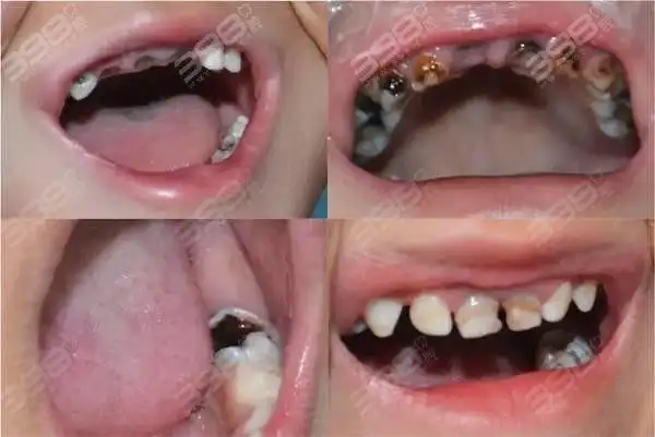 宝宝门牙乳牙被腐蚀图片