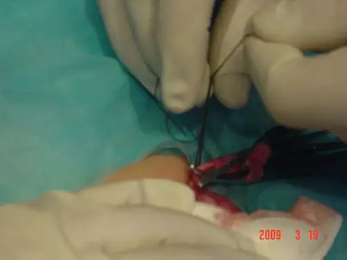 小切口疝囊高位结扎术组图