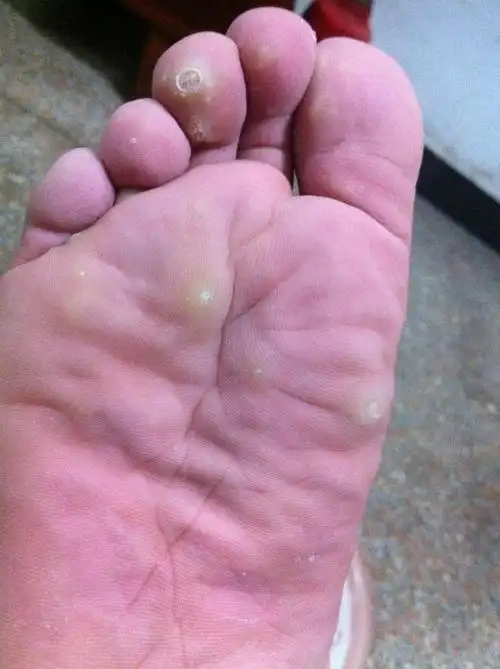 脚上有一颗颗的白点