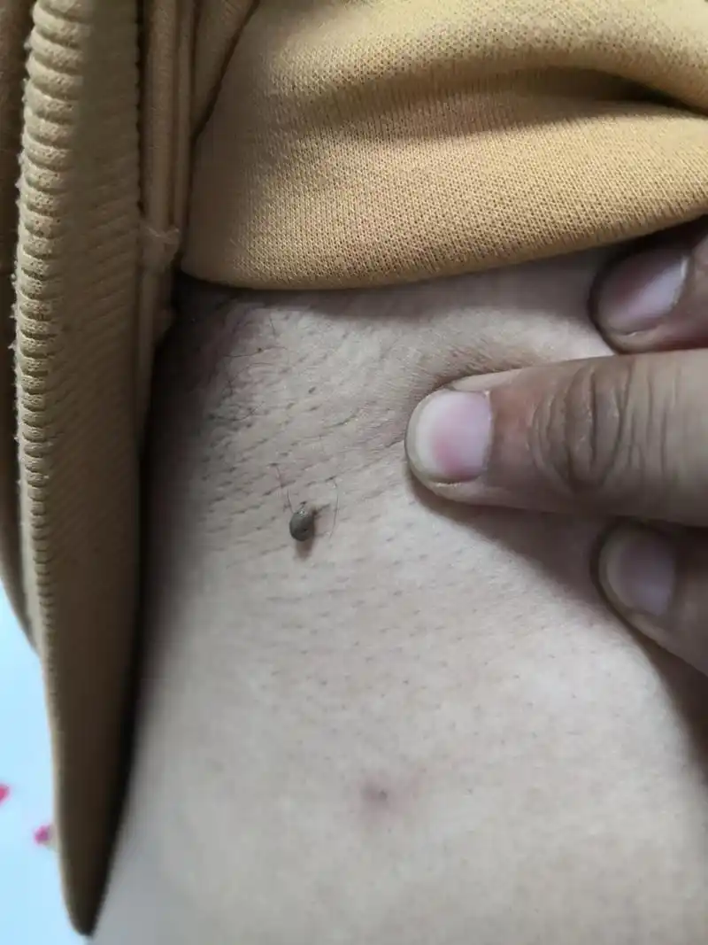 颈周腋下皮赘和腰部色素痣#解决皮肤问题专注皮肤美容# 可以使用激光