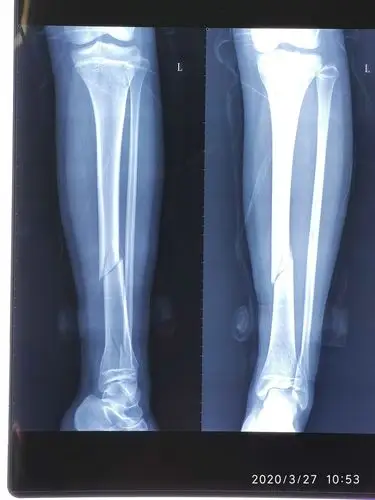 儿童胫腓骨骨折的治疗