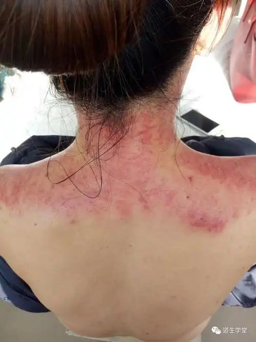 李氏砭法丨刮痧调治项背强几几有感