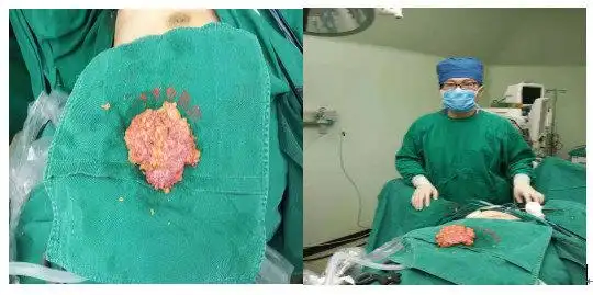 癌---【单孔腔镜技术在乳腺外科中的应用(4)】_男性乳房肥大_男性乳房