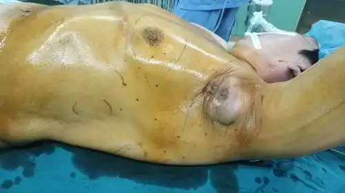 乳腺外科—背阔肌带蒂皮瓣转移修复乳腺癌伴腋窝肿瘤切除术后巨大创面