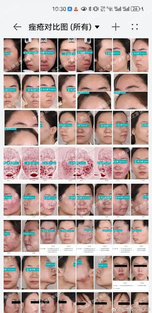 痘痘##祛痘##祛痘印