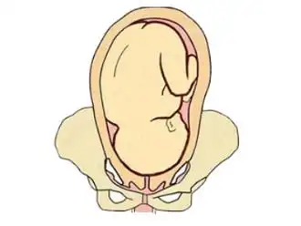 臀位比较可能破水吗3