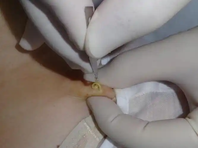 术后无痕-多发性脂囊瘤的微创治疗 - 好大夫在线