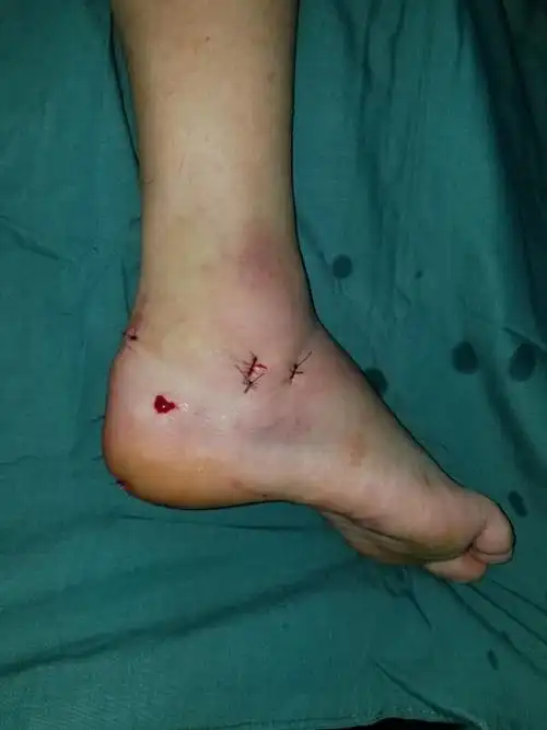 3米高脚手架上摔下,男子双脚跟骨粉碎性骨折 - 中国徐州网