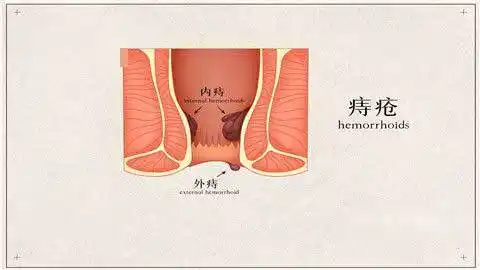 女性割痔疮需要住院吗
