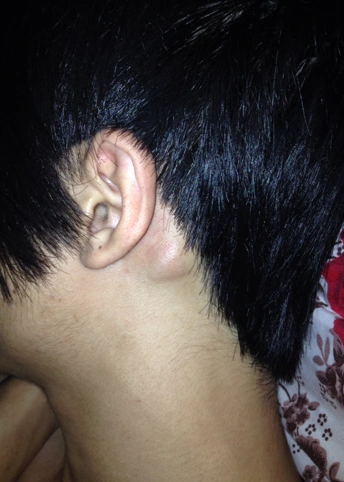 手臂皮下脂肪瘤图片