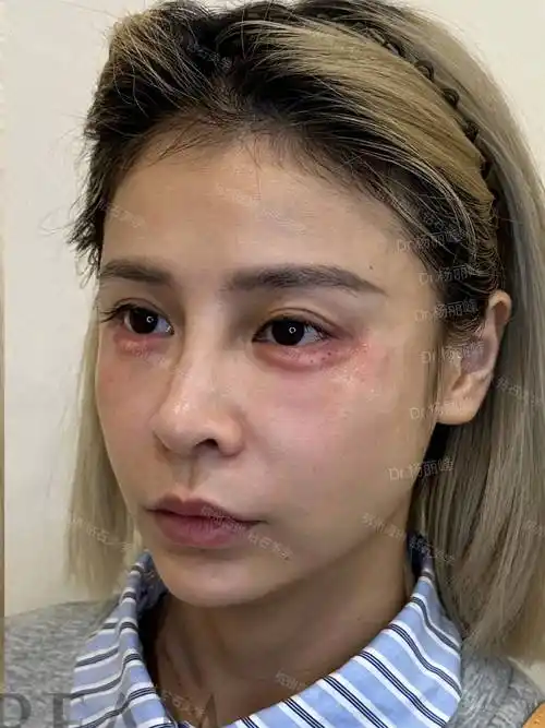 卧蚕注射 灵动双眼💕dr.杨丽峰👩‍⚕️