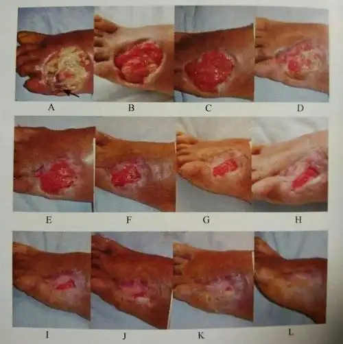 患者张某伤口愈合过程