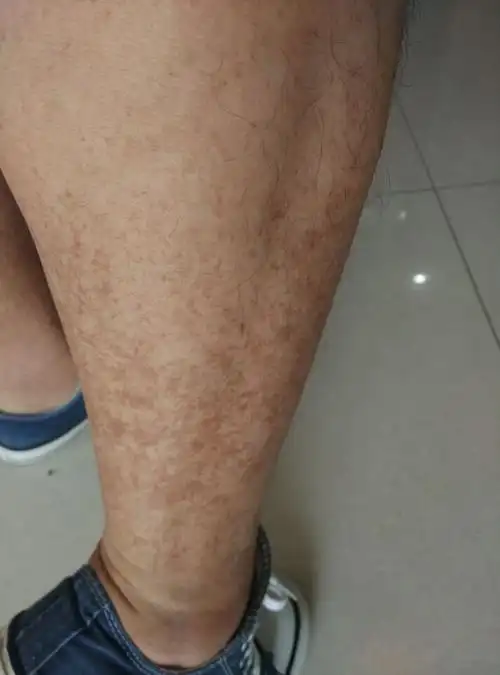 小腿上出的这些褐色斑点是什么?