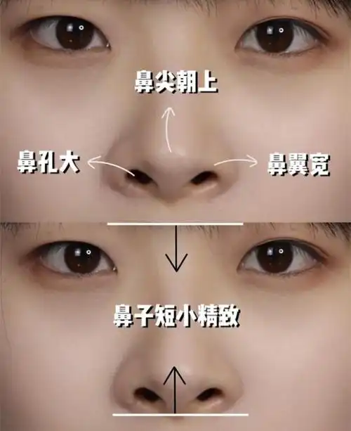 比"塌鼻子"更可怕的是"鼻孔外露",显老又显凶,你是什么鼻型