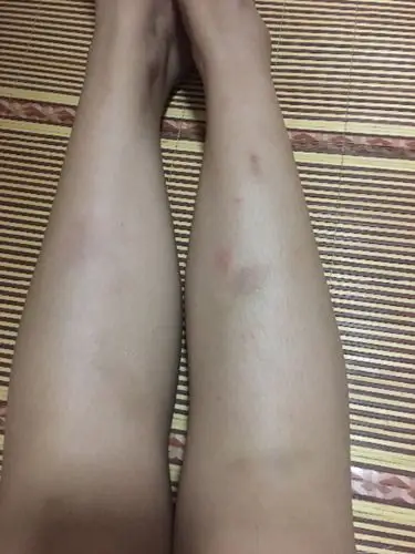 最近一个月小腿上无缘无故有淤青,好了又有,也没有磕碰过,按一下疼