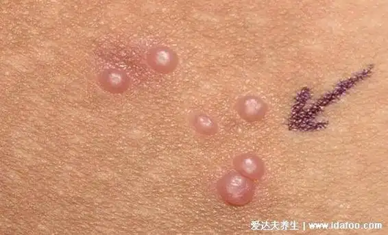 1,梅毒梅毒分为一期,二期,三期,早期会在男性的阴茎,龟头,包皮,尿道口