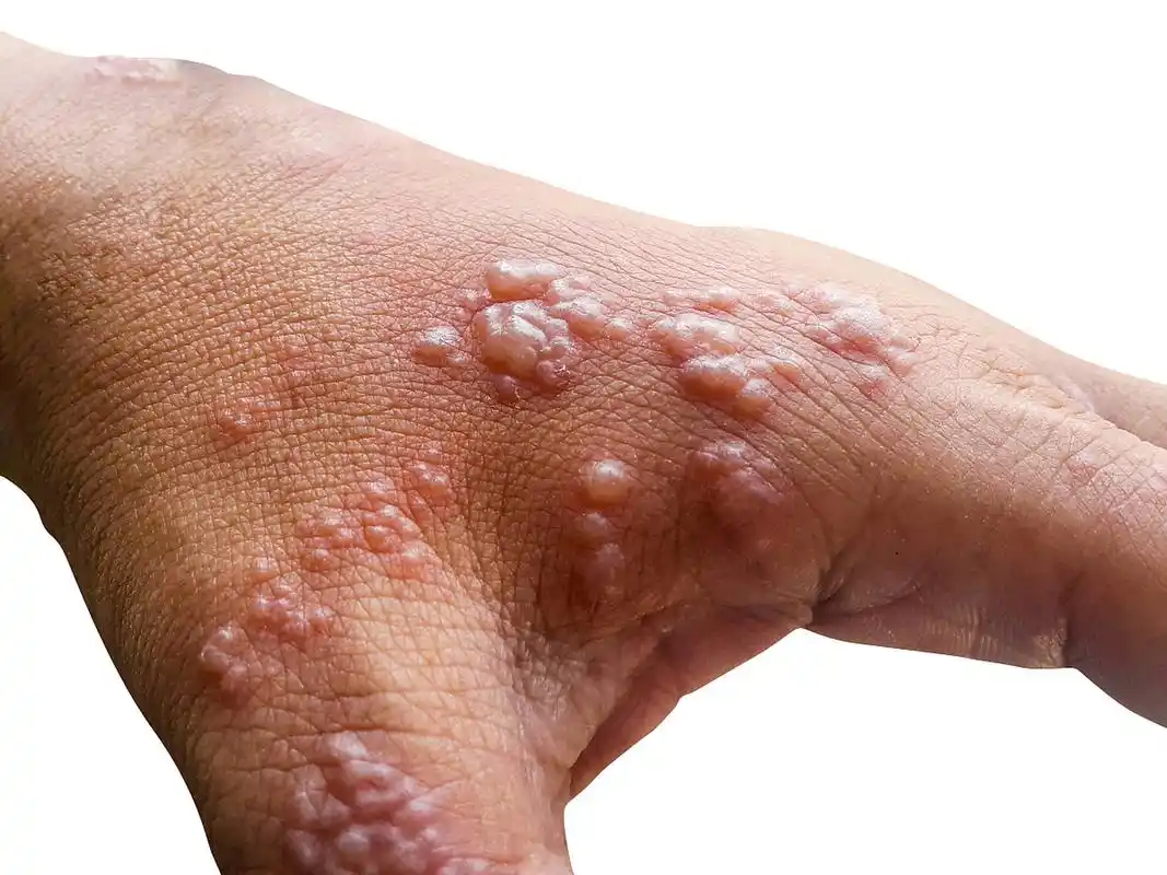 汗疱疹是一种常见的皮肤病,通常发生在炎热潮湿的环境中.