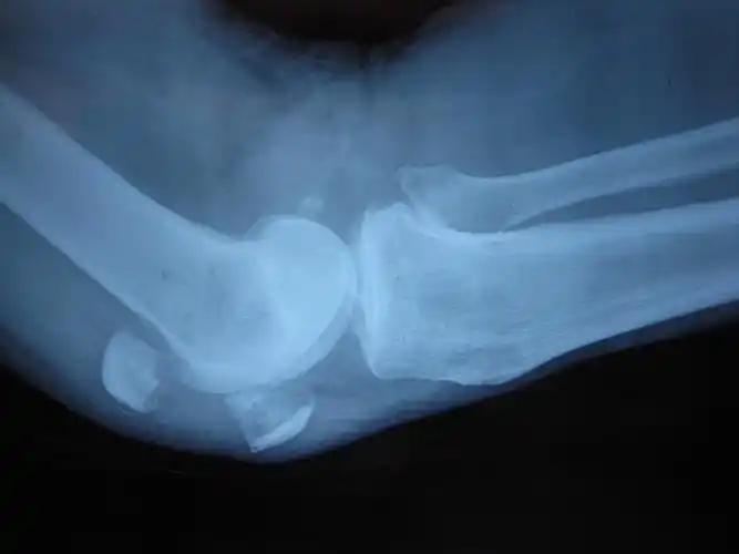 征集髌骨骨折x光片按要求提供给予积分