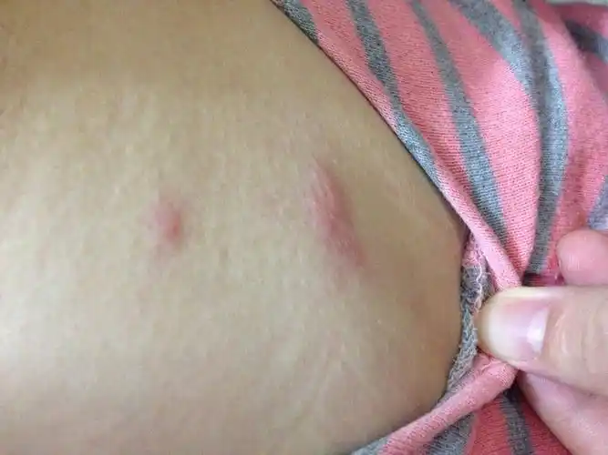 身上长了红点,很痒,不知道是什么皮肤病,求解