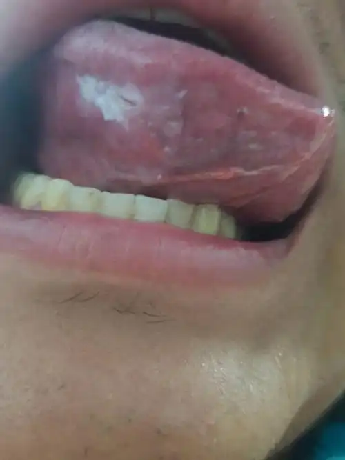 舌头被牙齿咬了,,这个白色斑纹很久了