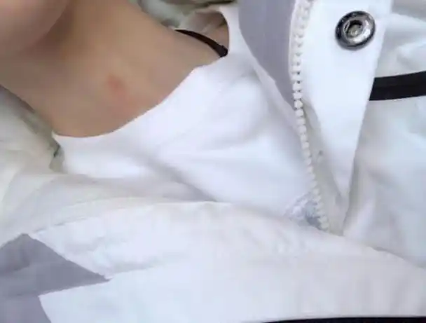 脖子草莓怎么去