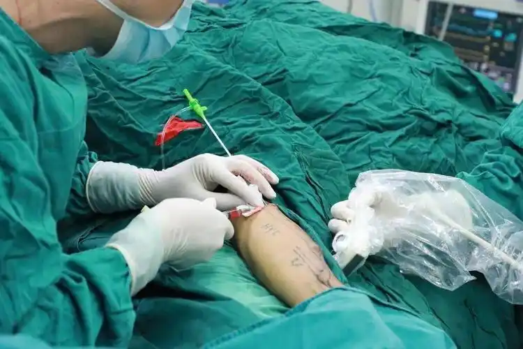 在为患者行动静脉内瘘狭窄球囊扩张术史应龙与周太恩联合覃秋梅手术