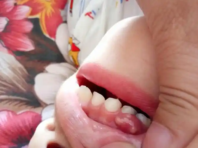 宝宝牙浆上长了个大包,看着感觉是脓包是怎么回事?