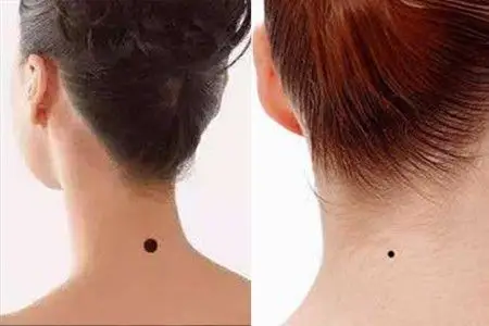 【图】脖子后面有痣代表什么意思 这些你了解吗