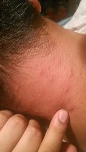 请问这是淋巴结肿大么?谢谢