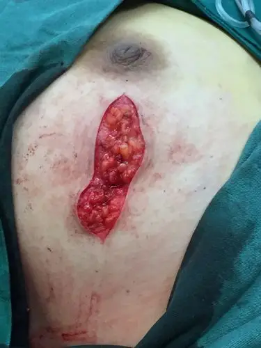 女性中年患者巨大乳腺纤维瘤