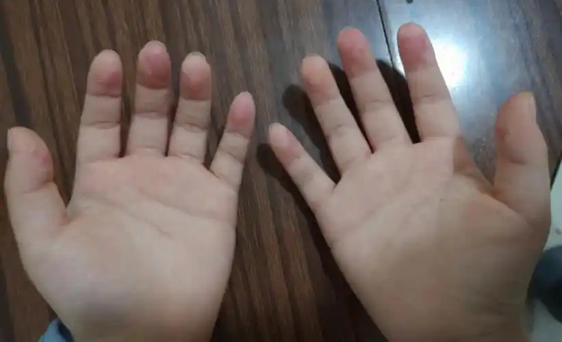 2月7号(图3)想起来拍了一下,确实好转不少,7号后来也没喝药没外