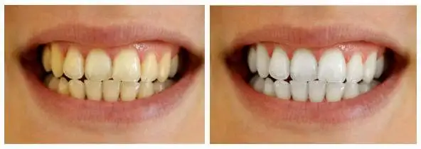 黄牙美白前后对比