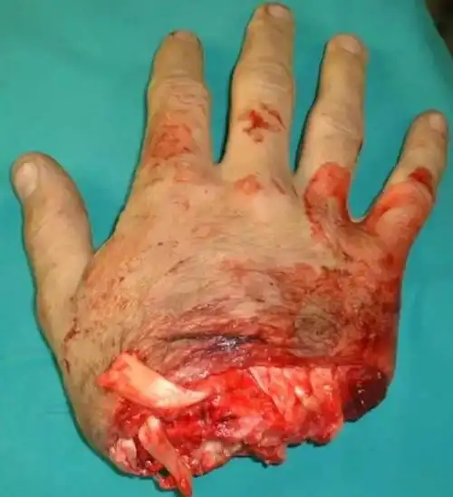 双十一剁掉的手接上了吗