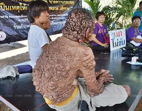 苏扎伊的主治医生表示,这是一种神经纤维瘤,虽不会严重到威胁病人的