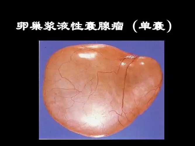 卵巢浆液性囊腺瘤(单囊)
