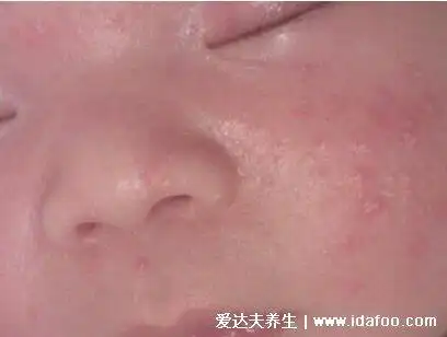 百分百!婴儿脸上湿疹怎么办"妈咪百科"-第1张图片-云飞博客