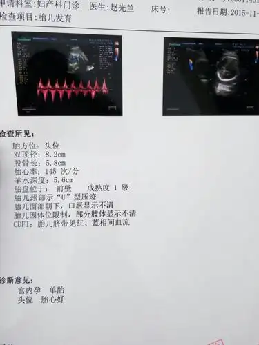 我宝宝的双顶径是不是大了,u型压痕又是啥东西,宝宝没事吧