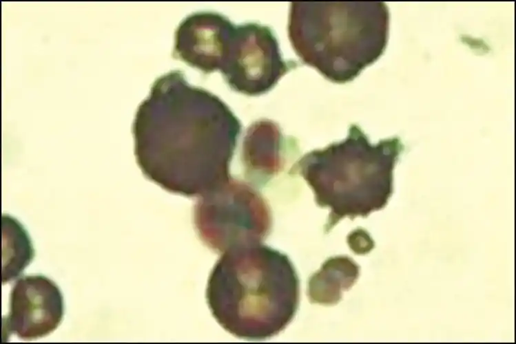 亮氨酸结晶尿亮氨酸蛋白质分解产物,见于组织大量坏死的疾病.