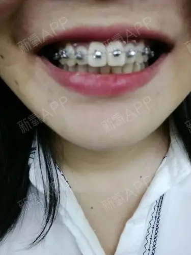 牙齿从10岁左右两个门牙就开始前突,而且门牙很大,_圈子-新氧美容整形