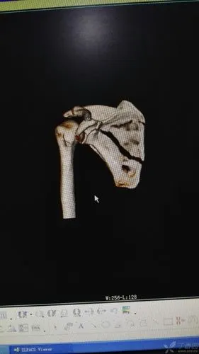 肩胛骨骨折,求讨论