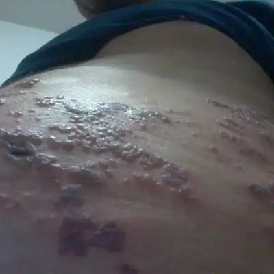 带状疱疹会头痛吗