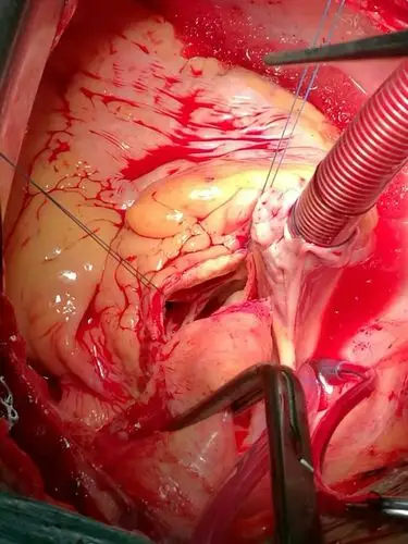 冠脉搭桥 主动脉瓣置换 二尖瓣成型术 - 好大夫在线