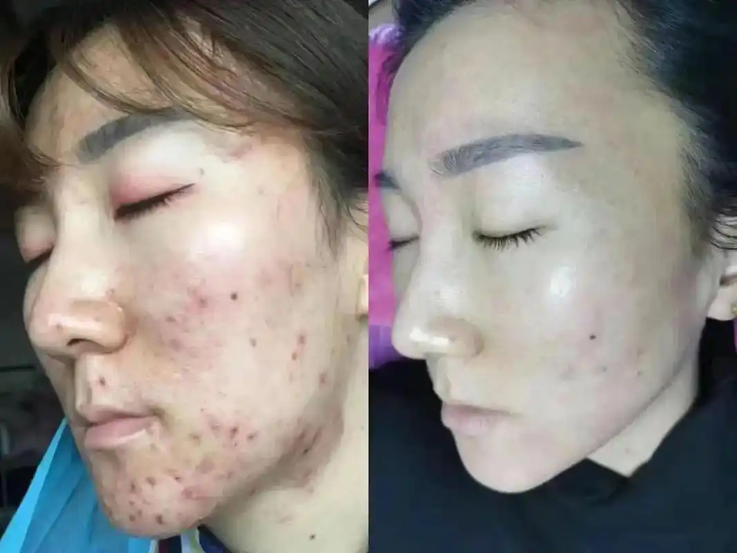 专业调理痘痘肌肤顾客发来照片调理痘痘前后对比图#问题性皮肤 - 抖音