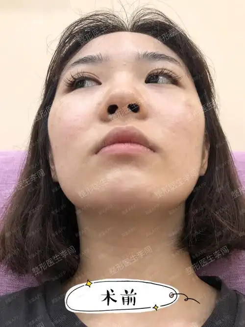 膨体垫鼻基底还能改善法令纹?