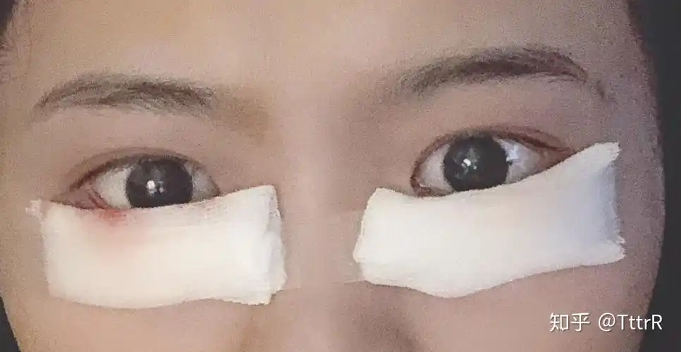 开个倒睫手术的记录吧