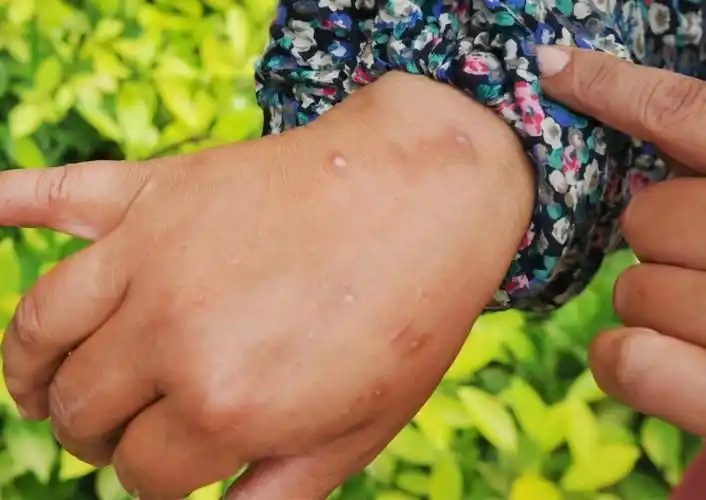 3岁孩子被红火蚁咬后,妈妈的"三个果断"救了娃,医生:有见识